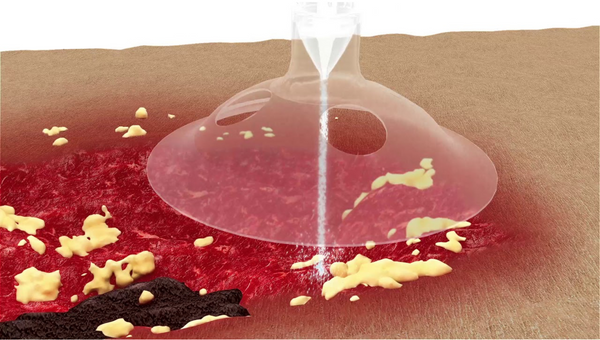 Cutting Edge Technology: Hydro-debridement with the JetOx™ System